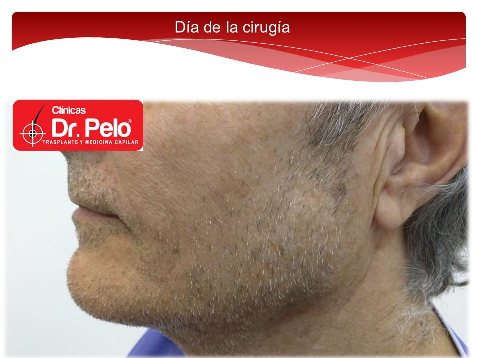 [Imagen: injerto-capilar-barba-clinicas-dr-pelo-d...arba-2.jpg]