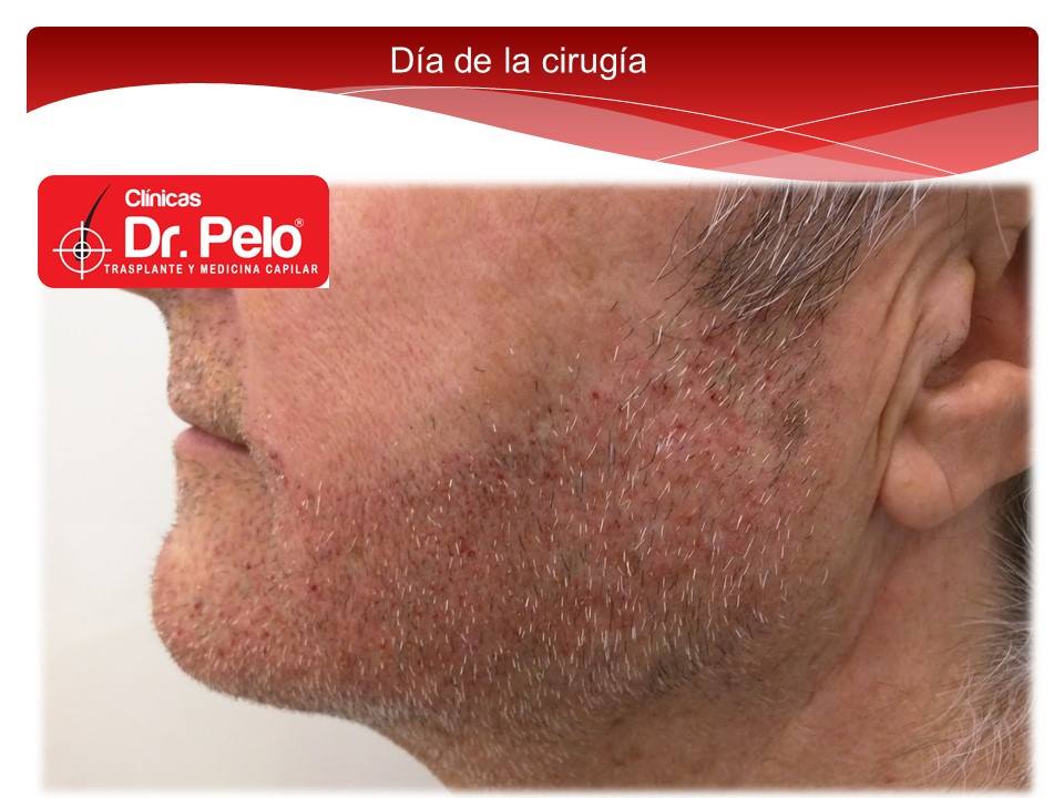 [Imagen: injerto-capilar-barba-clinicas-dr-pelo-d...arba-5.jpg]