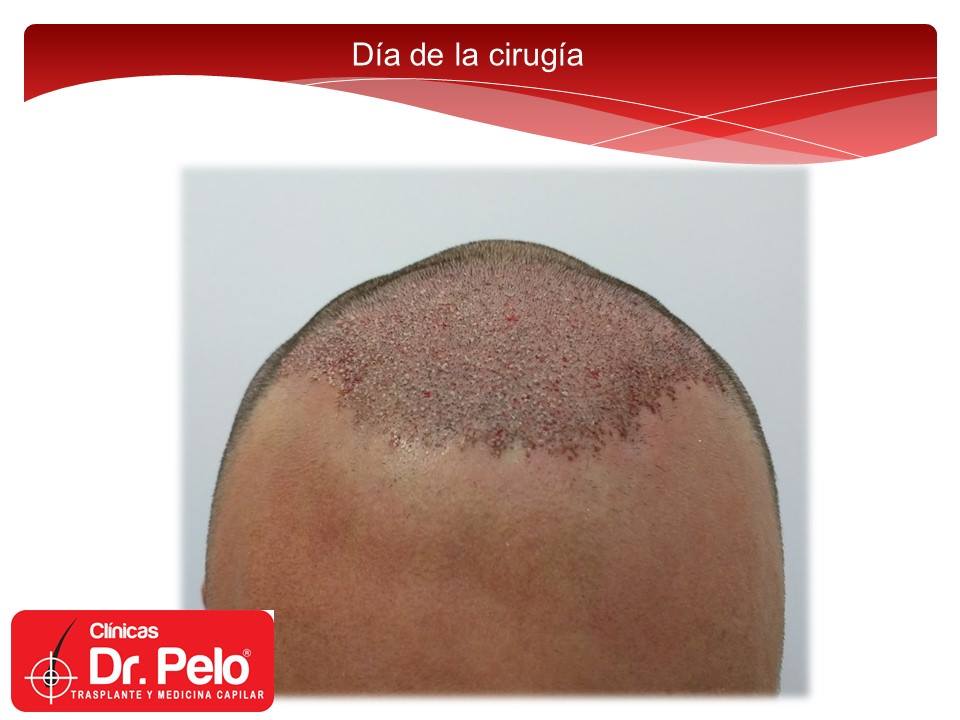 [Imagen: injerto-capilar-fue-clinicas-dr-pelo-dr-...or-6-1.jpg]