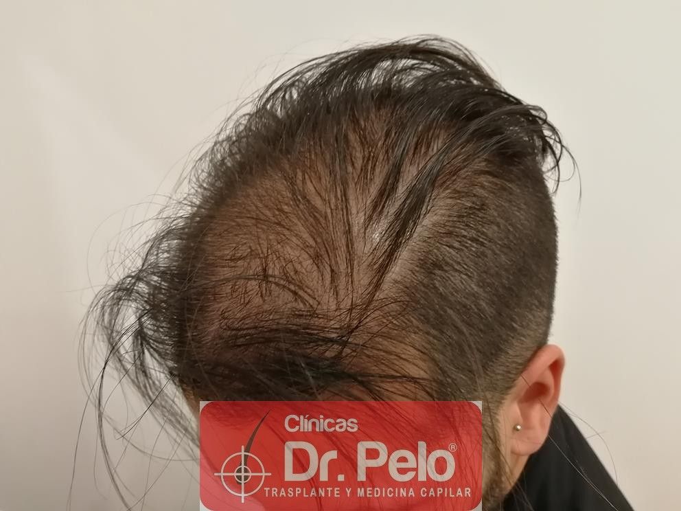 Alopecia difusa, y tratamiento - Clínicas Dr.Pelo