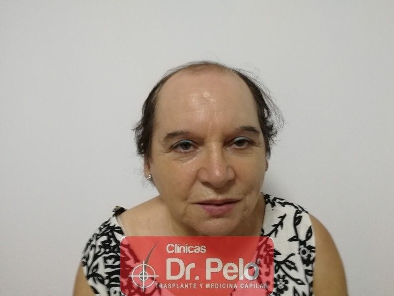 [Imagen: mujer-cirugia-capilar-dr-pelo-sevilla-ba...ida_13.jpg]