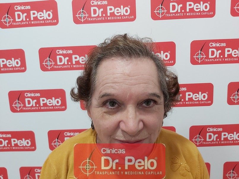 [Imagen: mujer-cirugia-capilar-dr-pelo-sevilla-ba...rida_3.jpg]