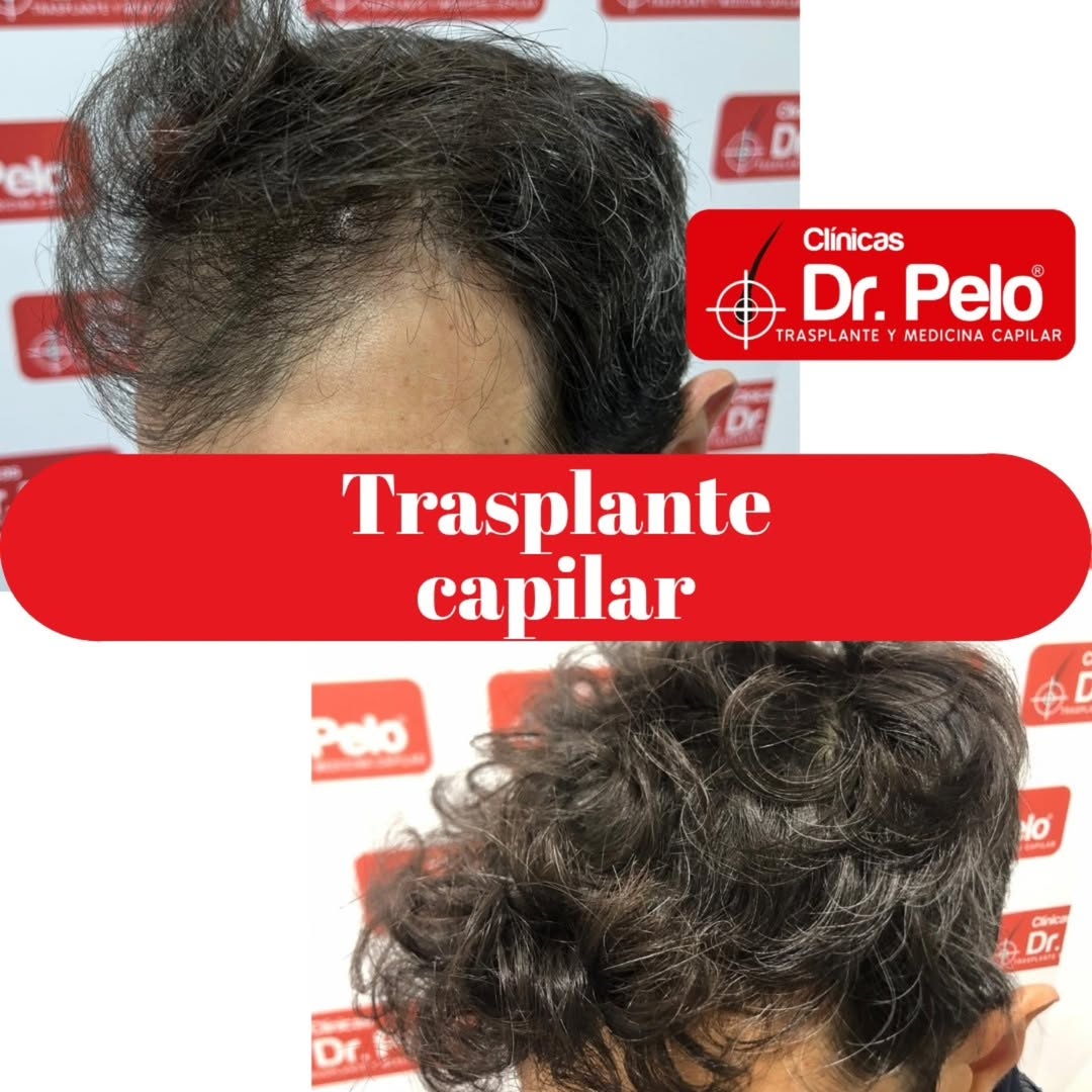 injerto capilar