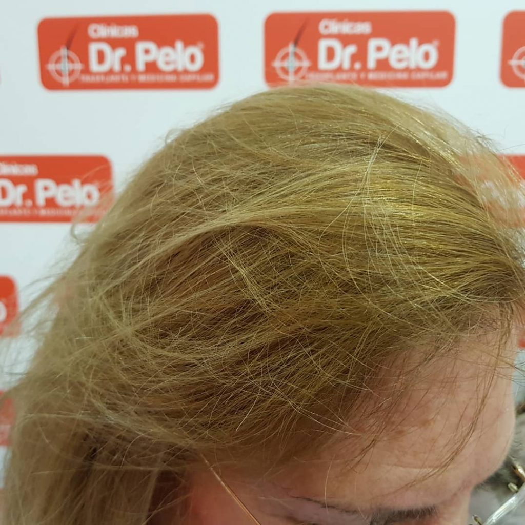 [Imagen: injerto-capilar-mujer-1-1-1024x1024.jpg]