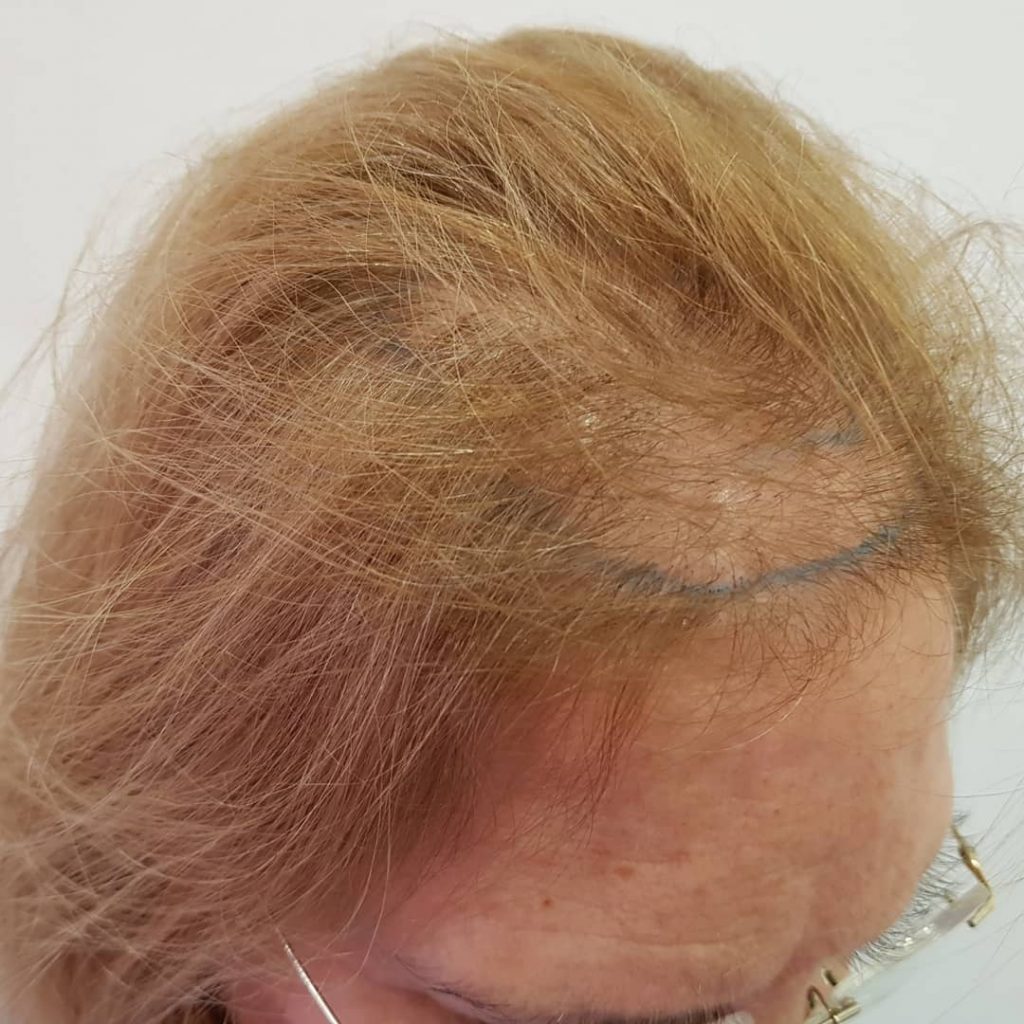 [Imagen: injerto-capilar-mujer-1-10-1024x1024.jpg]