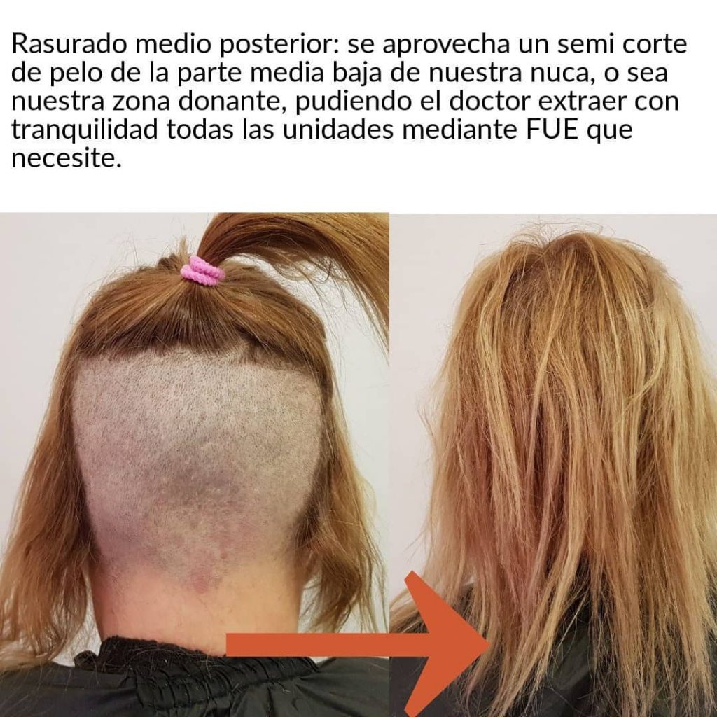 [Imagen: injerto-capilar-mujer-1-3-1024x1024.jpg]