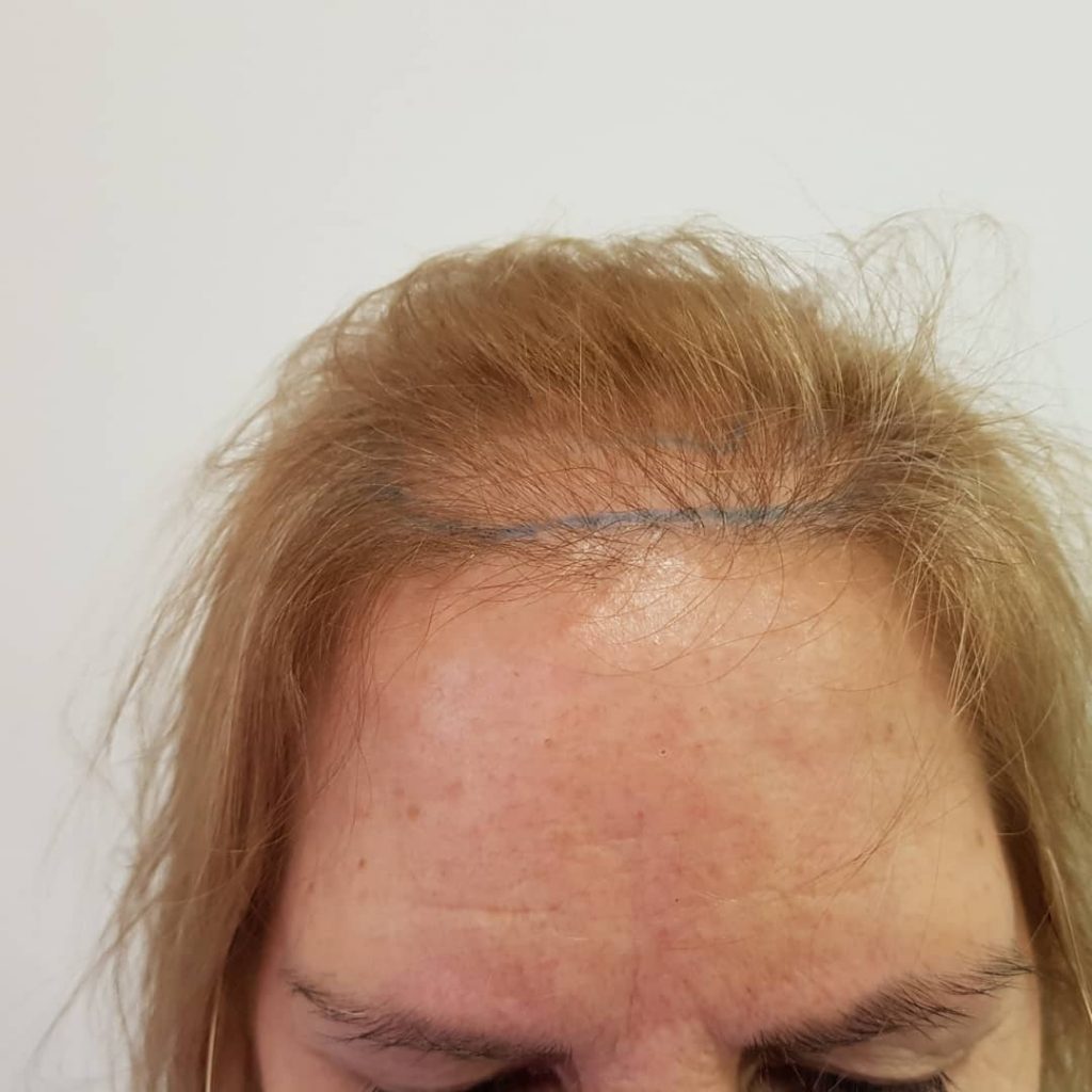 [Imagen: injerto-capilar-mujer-1-4-1024x1024.jpg]