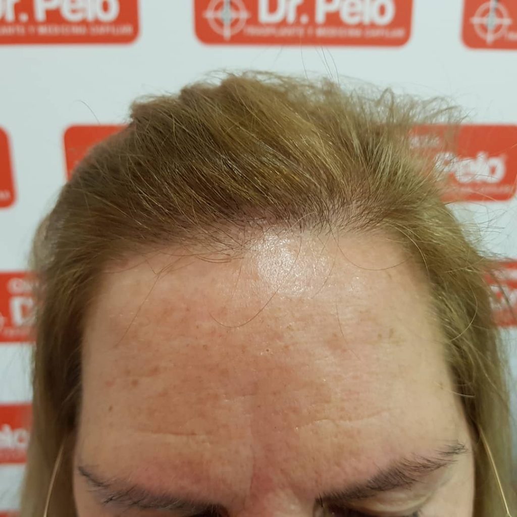 [Imagen: injerto-capilar-mujer-1-5-1024x1024.jpg]