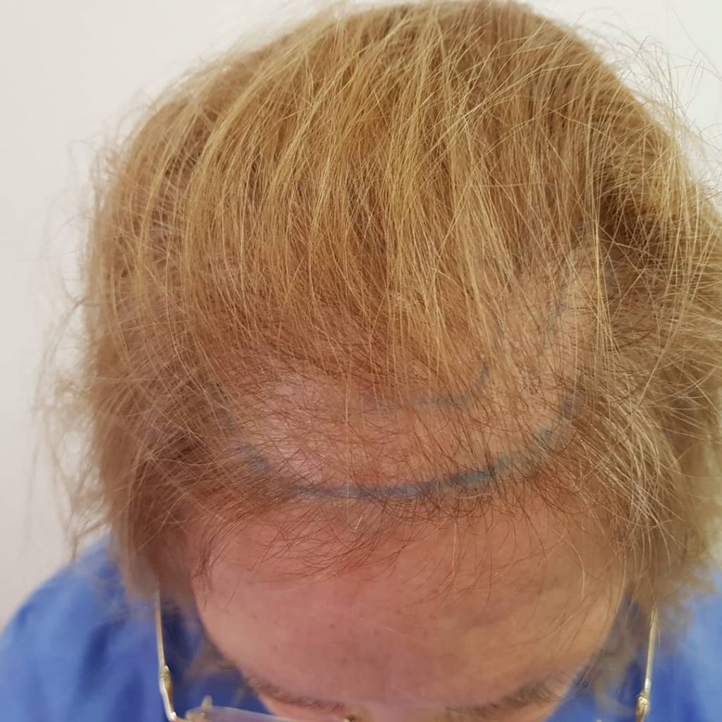 [Imagen: injerto-capilar-mujer-1-6-1024x1024.jpg]