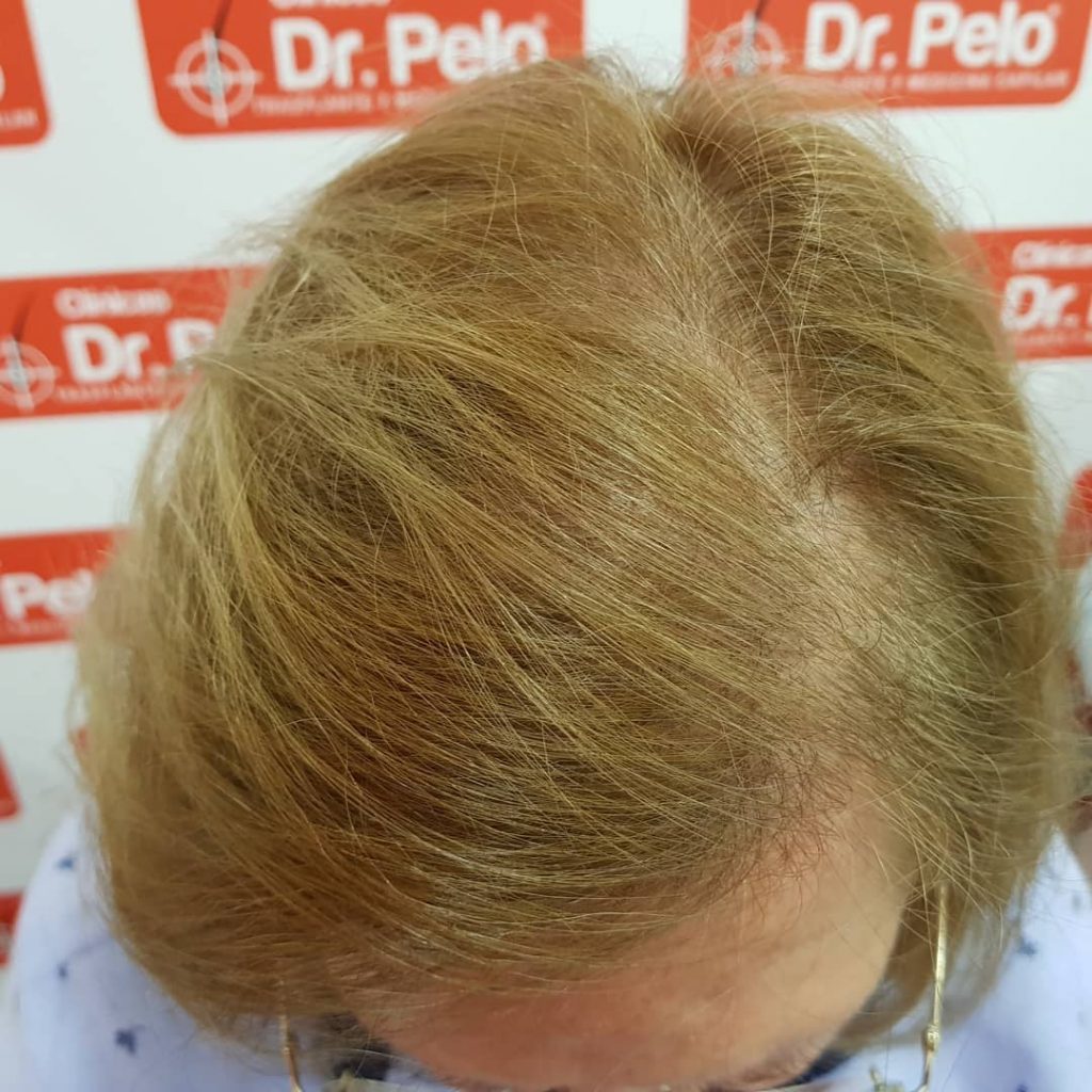 [Imagen: injerto-capilar-mujer-1-7-1024x1024.jpg]