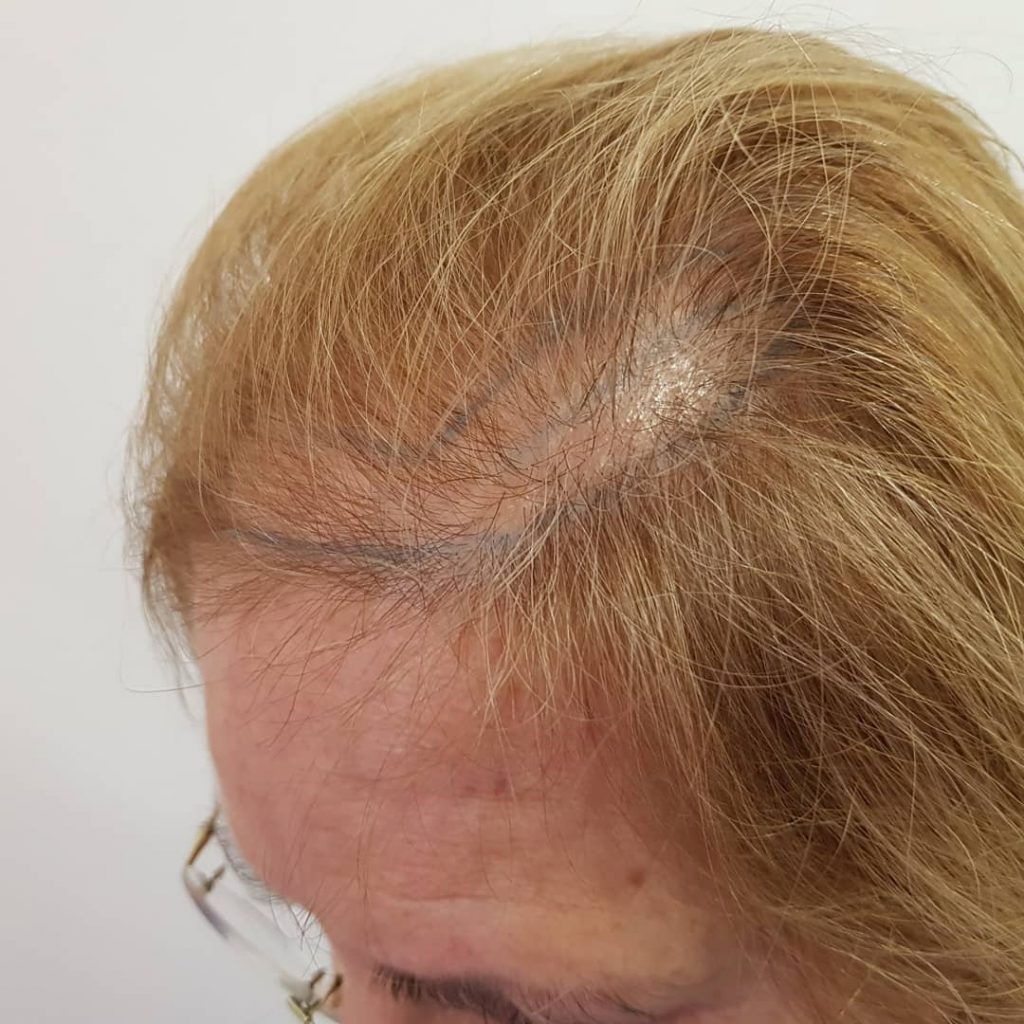 [Imagen: injerto-capilar-mujer-1-8-1024x1024.jpg]