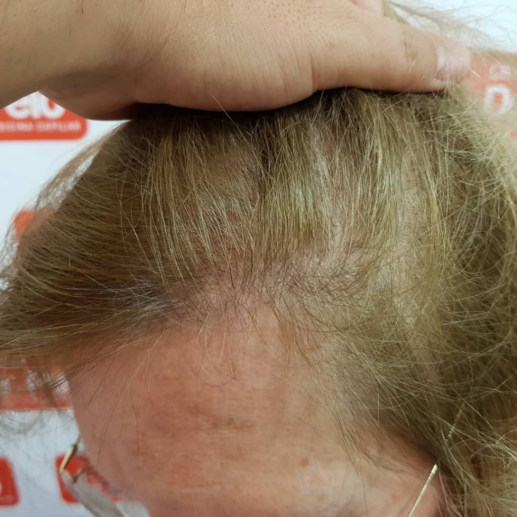 [Imagen: injerto-capilar-mujer-1-9-1024x1024.jpg]