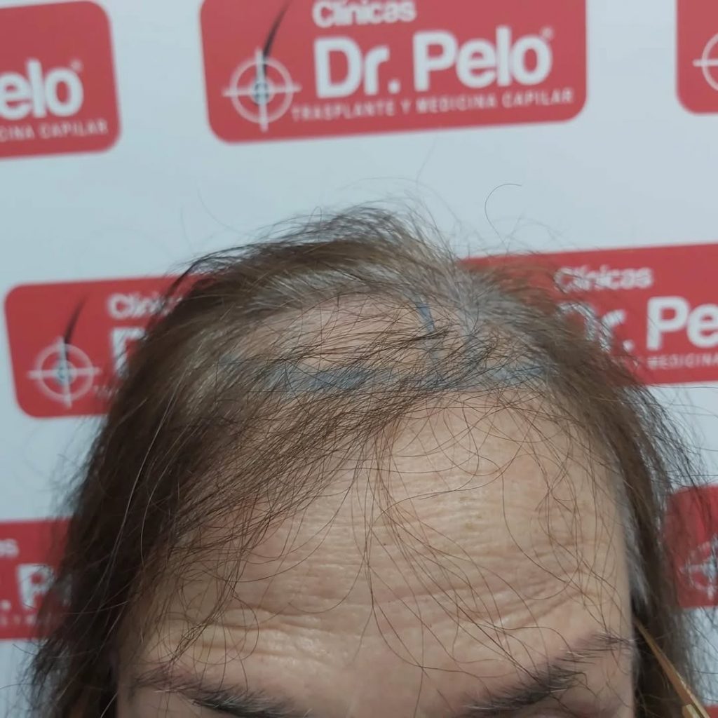 [Imagen: injerto-capilar-mujer-2-1024x1024.jpg]