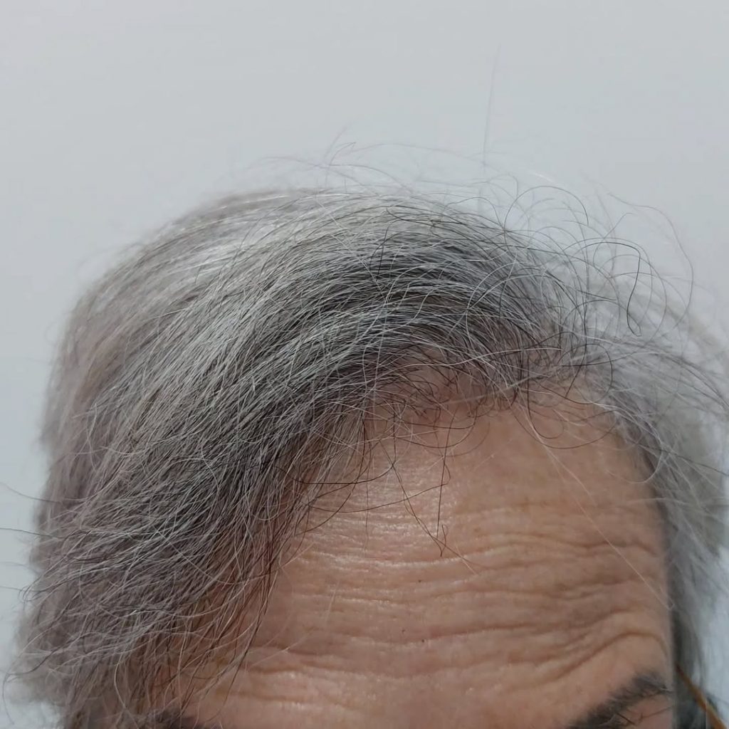 [Imagen: injerto-capilar-mujer-3-1024x1024.jpg]