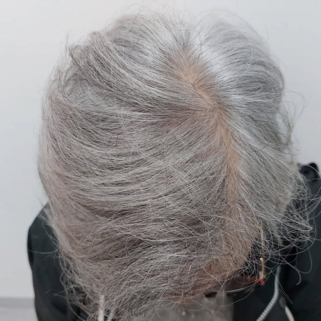 [Imagen: injerto-capilar-mujer-5-1024x1024.jpg]