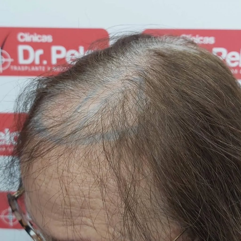 [Imagen: injerto-capilar-mujer-6-1024x1024.jpg]