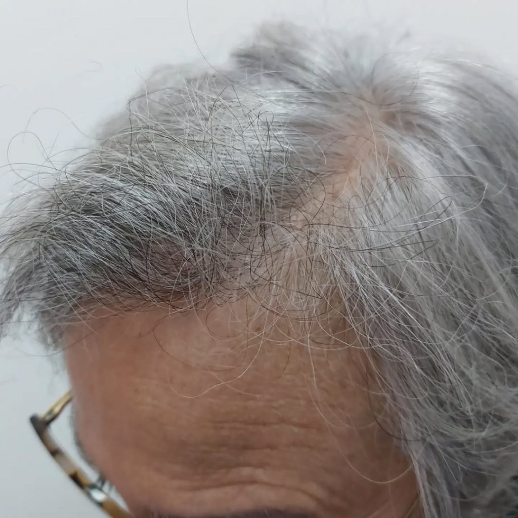 [Imagen: injerto-capilar-mujer-7-1024x1023.jpg]