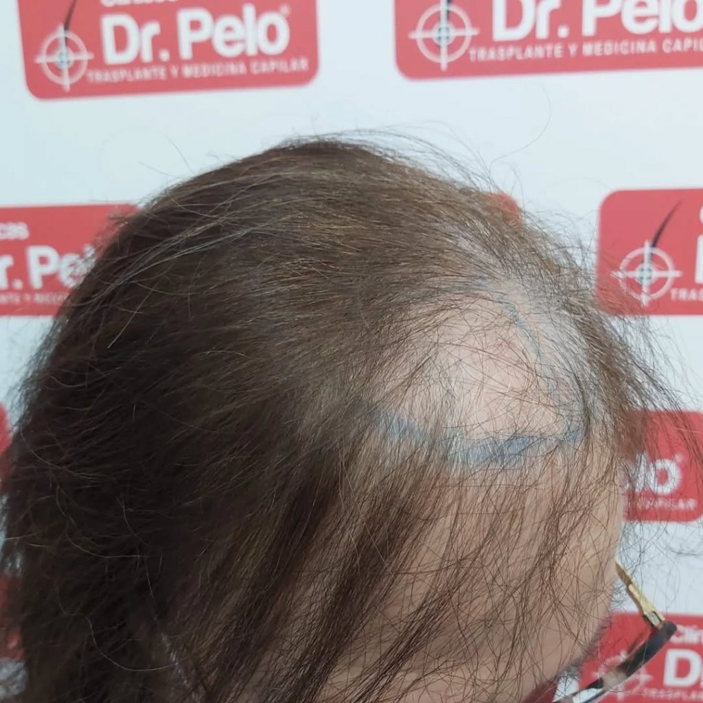 [Imagen: injerto-capilar-mujer-8-1024x1024.jpg]