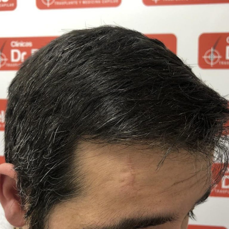 [Imagen: tratamiento-capilar-dr-pelo-3-768x768.jpg]